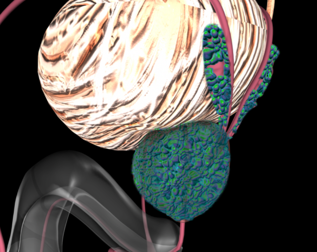 Prostate cancer